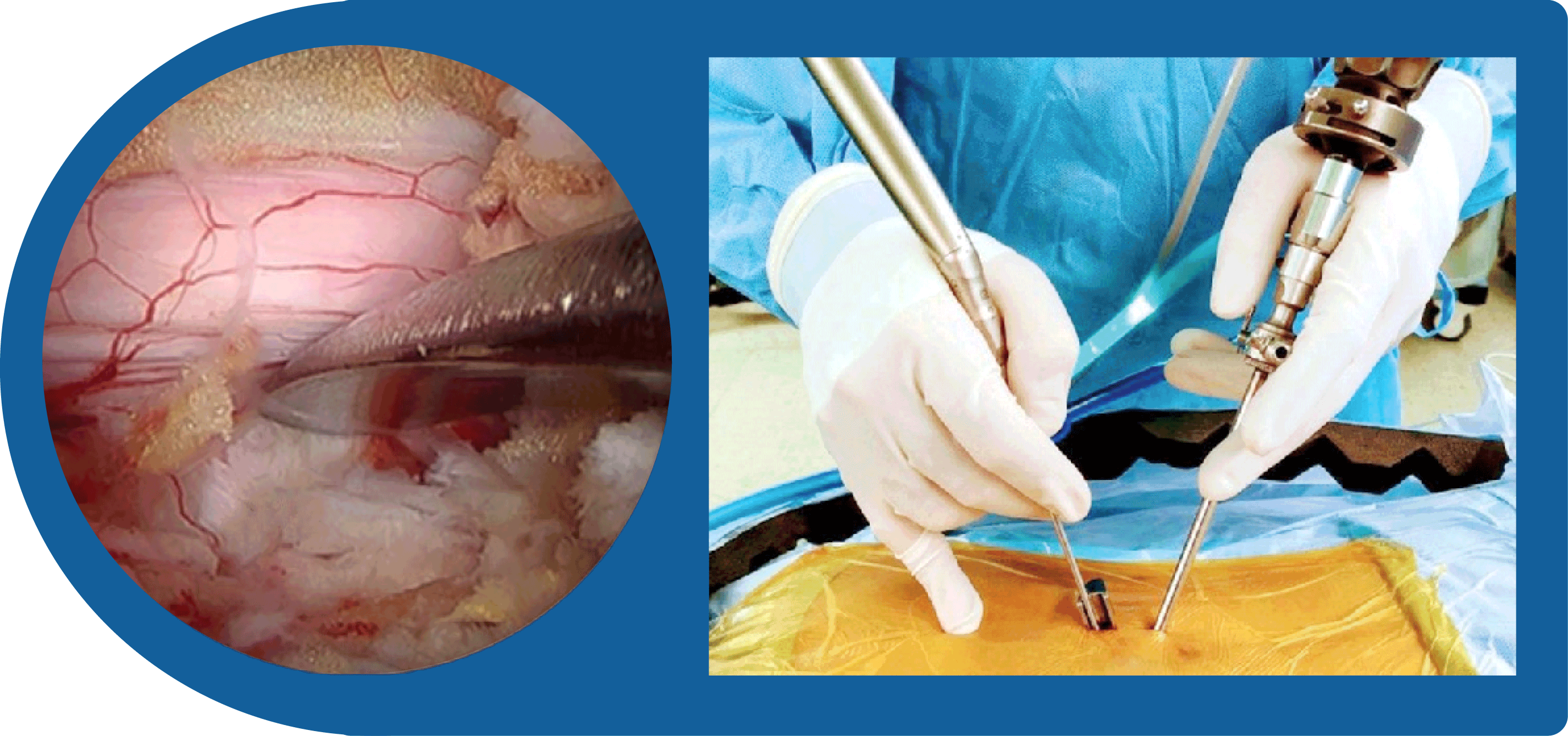 Endoscopic vs. Open Back Surgery