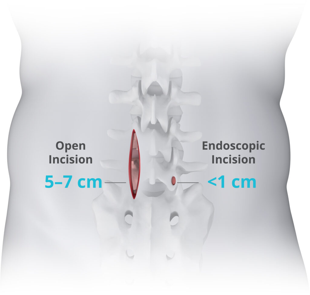 endoscopic vs. open surgery incision size