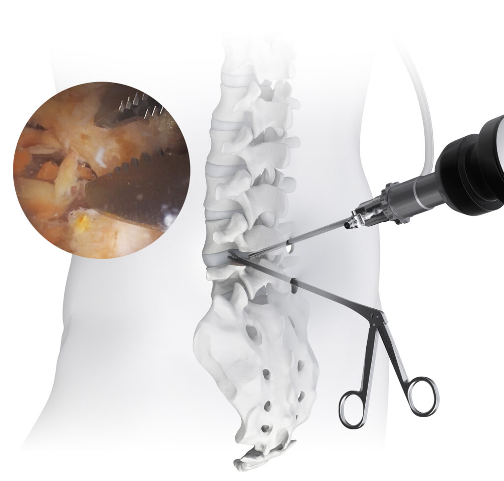 spine endoscopy